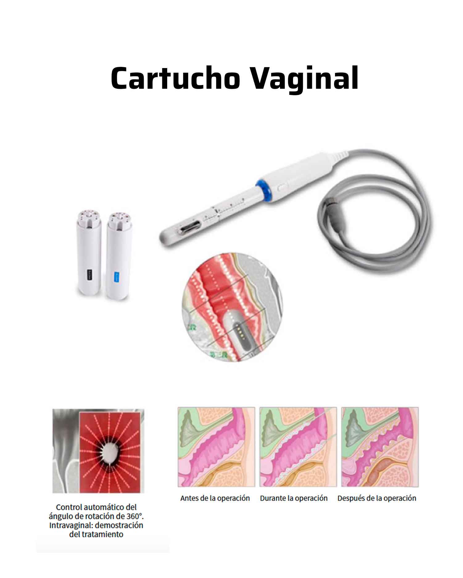 HIFU-MAX 4D facial, body and vaginal - 6 in 1